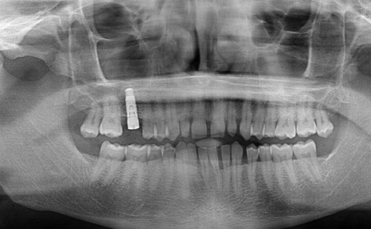 After Internal Sinus Lift 