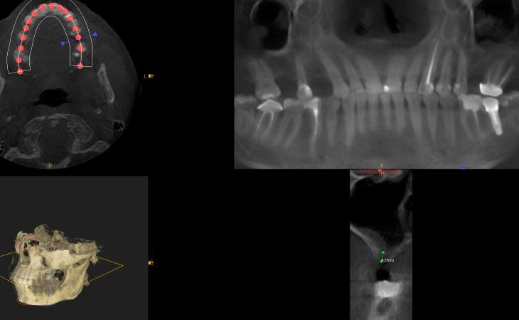 Before Bilateral Sinus Lift Surgery