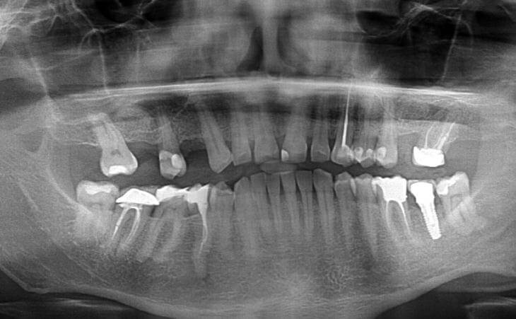 After Bilateral Sinus Lift Surgery