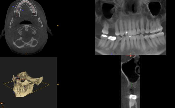 Before Internal Sinus Lift And Implant Placement