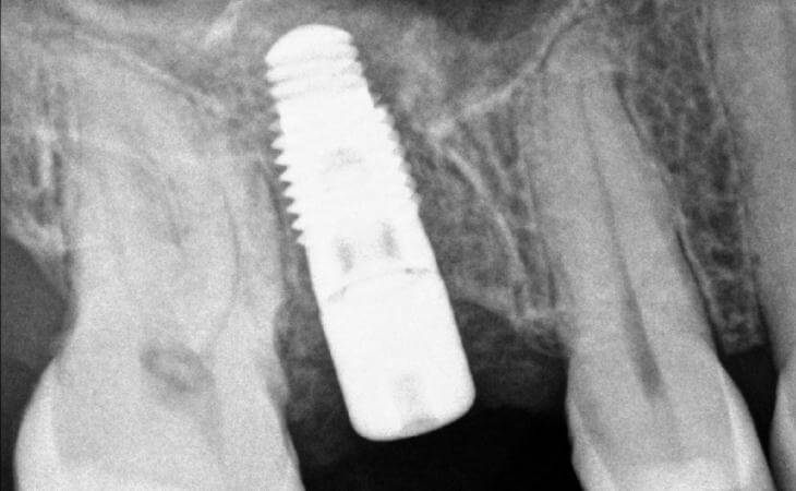 After Internal Sinus Lift And Implant Placement