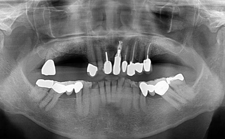 Post Bilateral Sinus Lift Surgery CAT Scan