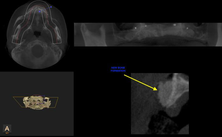 After Severe Upper Jaw Bone Loss