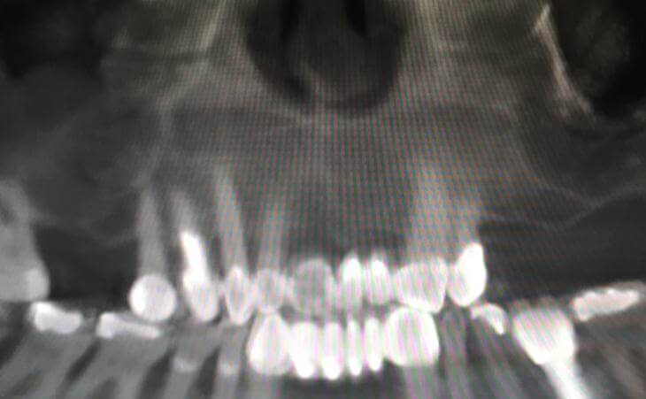 Before Bilateral Sinus Lift Treatment