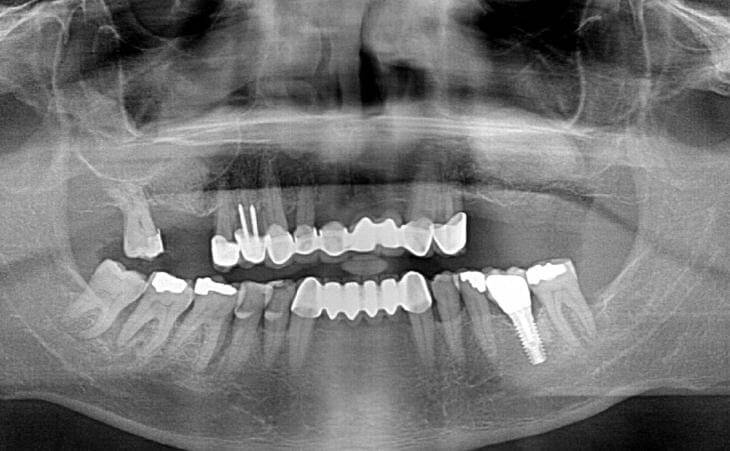 After Bilateral Sinus Lift Treatment