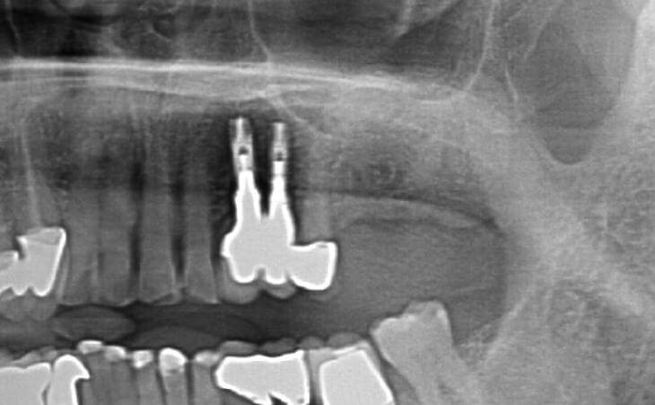 After Left Upper Jaw Sinus Lift Before