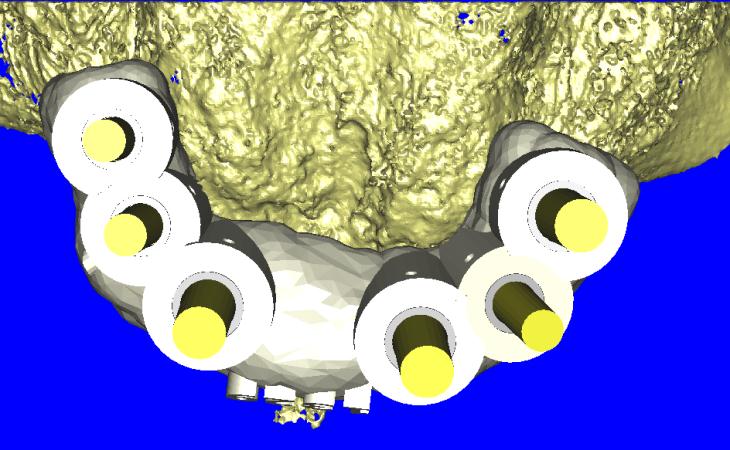 Surgical Virtual planning For Dental Implants