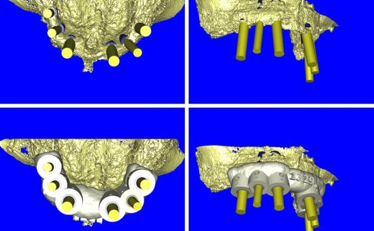 Dental Implant Planning And Guide Fabrication 