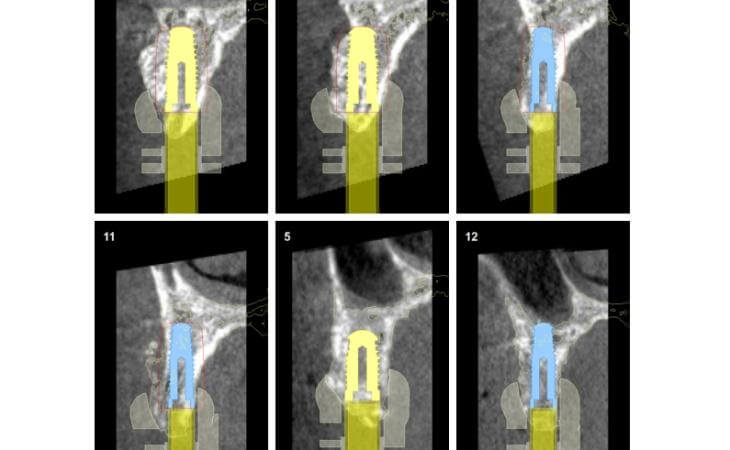 Ideal Implant Location