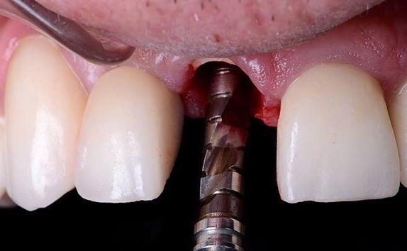 Tooth Extraction Before Dental Implant