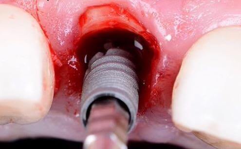 Proper Dental Implant Placement