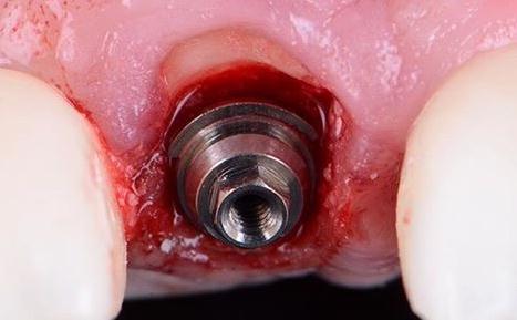 Dental Implant Abutment Placement