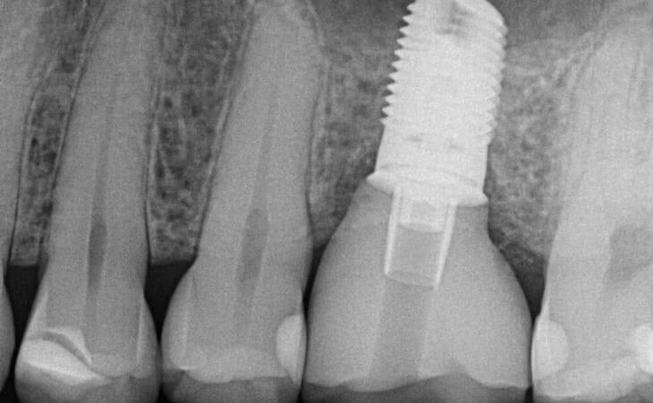 Dental Implant Crown