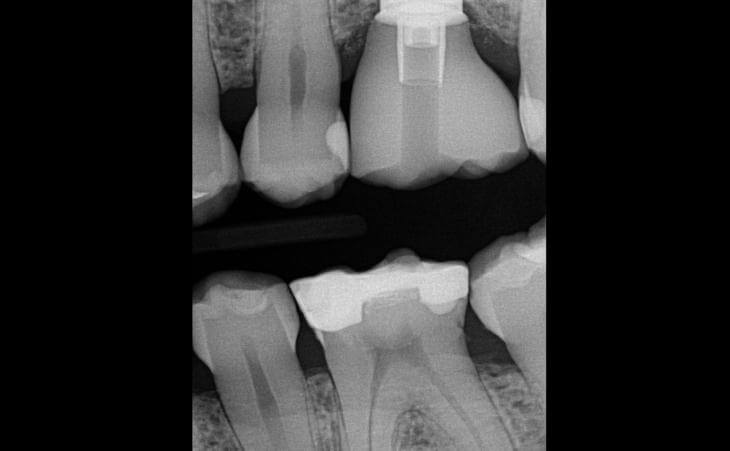Dental Crown For Tooth Replacement