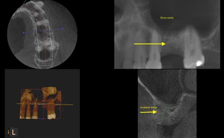 Molar Tooth Extraction