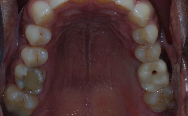 Dental Implant For Missing Molar