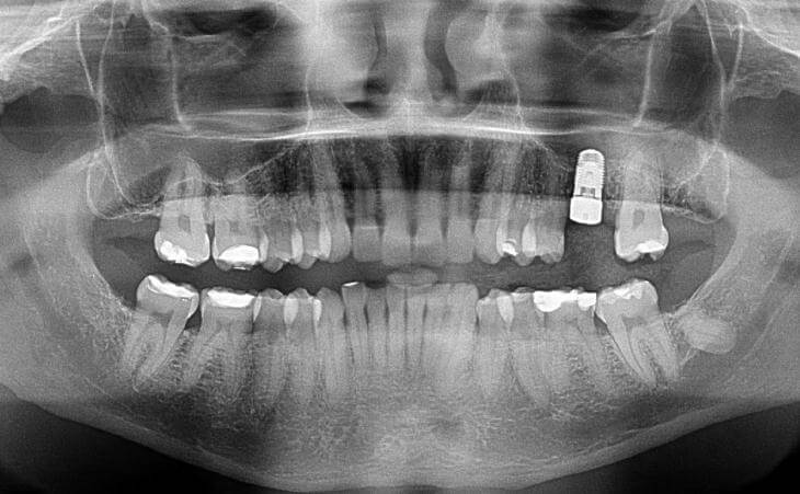 Dental Implant Through Guided Dental Implant Surgery