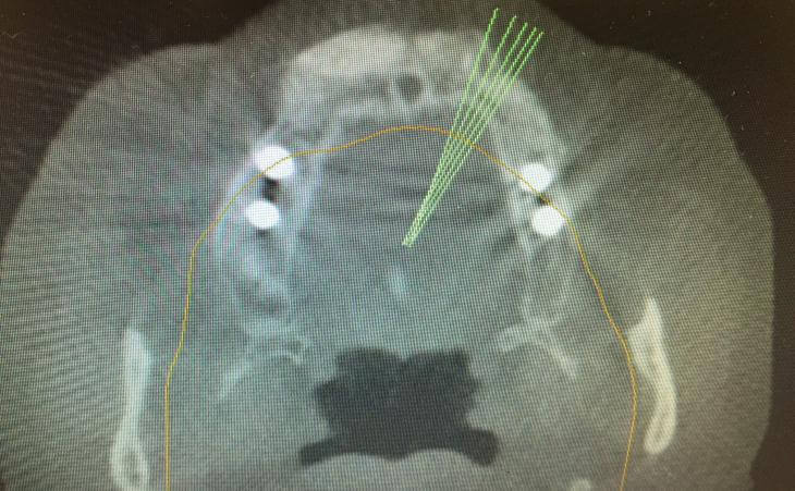 CT Scan Of Bone Grafting Results