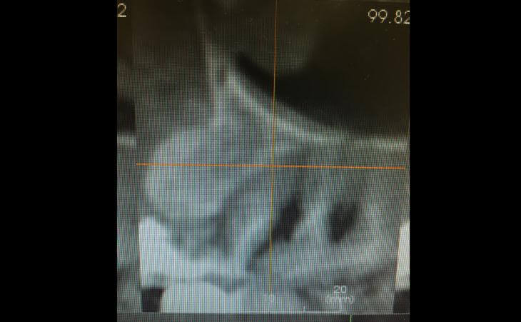 Reconstructed Dental Bone CT Scan