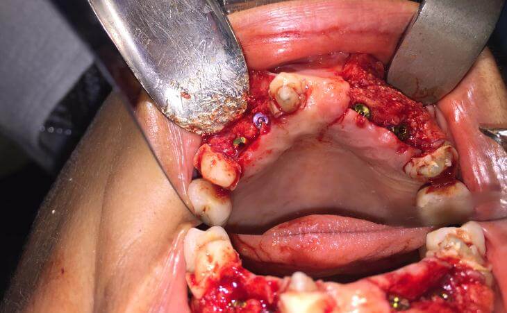 Dental Implants After Bone Regeneration