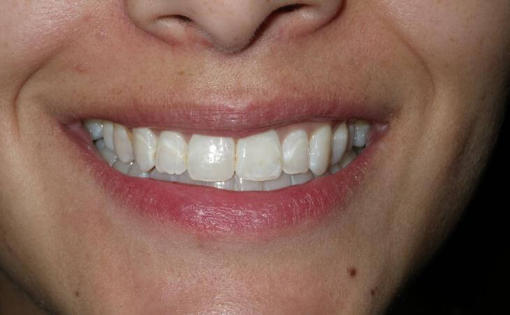 Small Upper Jaw Treatment Results