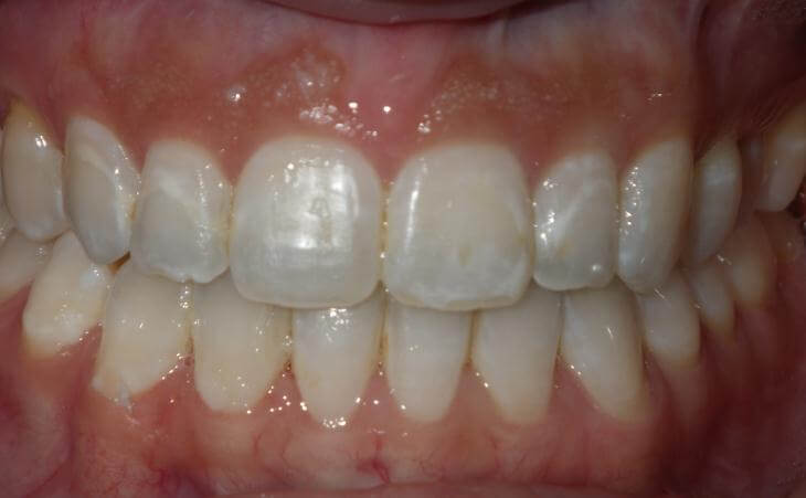 After Small Upper Jaw Treatment 