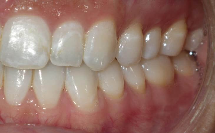 Results Of Small Upper Jaw Treatment