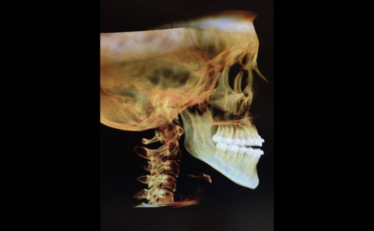 Large Lower Jaw Treatment