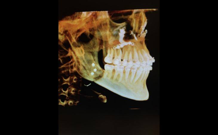 Open Bite Treatment Results CT Scan