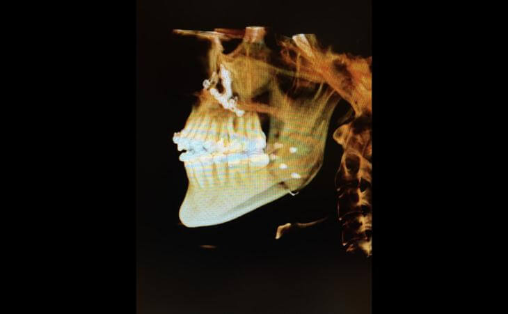 Post Open Bite Treatment CT Scan