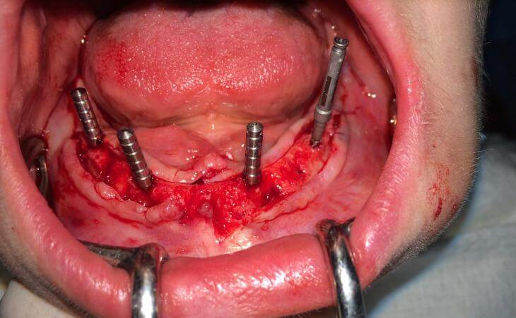 4 Implant OverDenture sURGERY