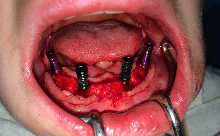 4 Implant OverDenture Placement