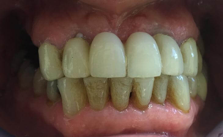 Decayed Tooth Removal