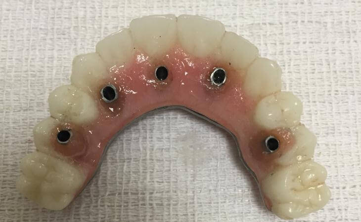 Natural-Looking Tooth Replacement