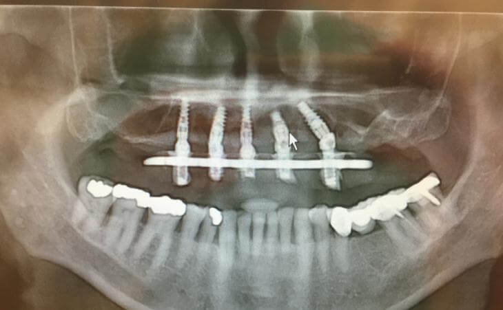 X-Ray Of Dental Implants
