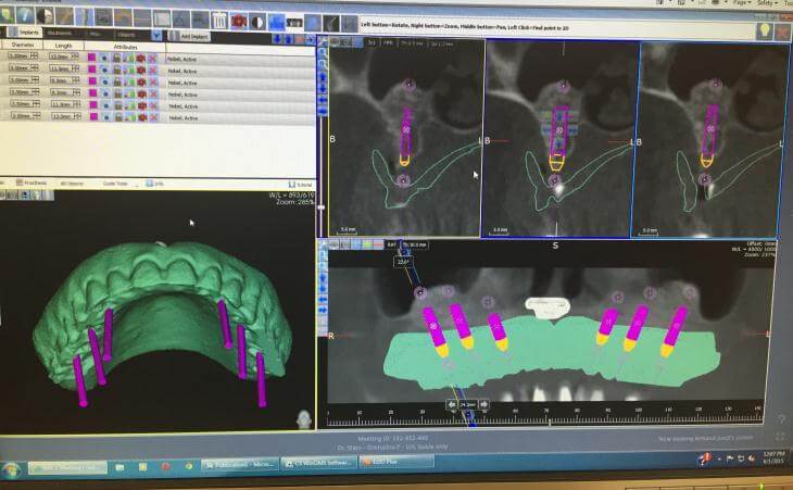 nSequence Guided Implant Surgery
