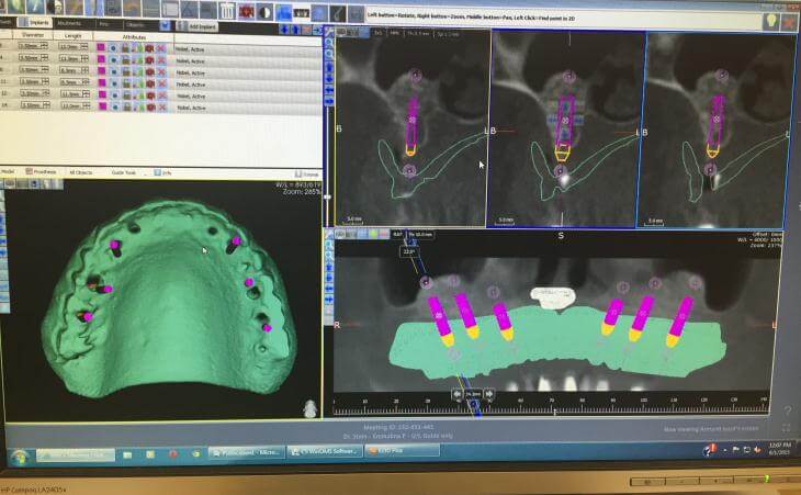 nSequence Guided Dental Surgery