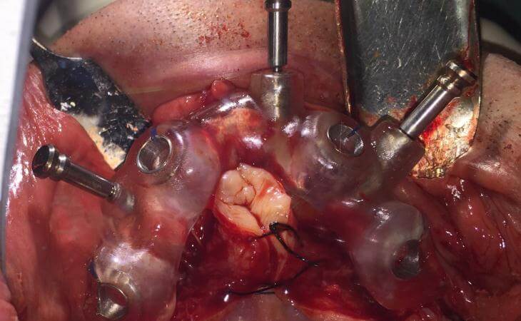 Surgical Guide For Tooth Replacement