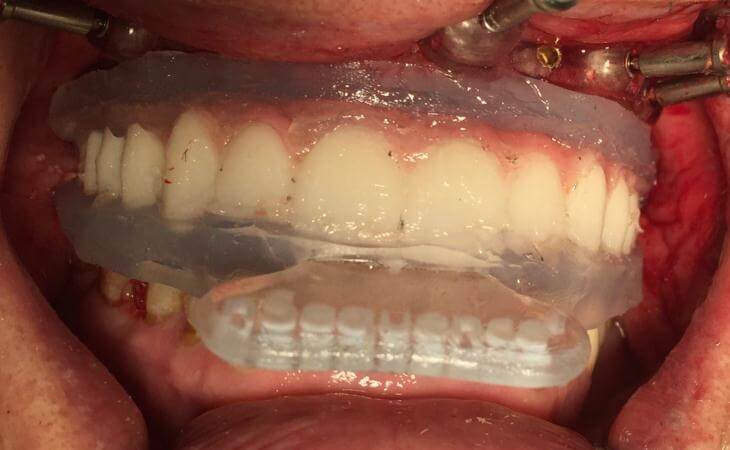 Dental Implant Placement With Surgical Guide