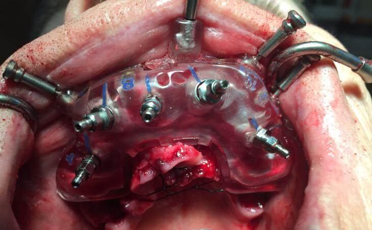 Placement Of Dental Implants