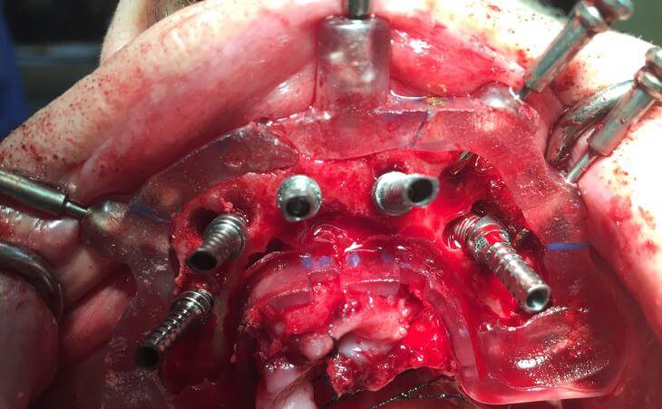 Dental Abutment Placement