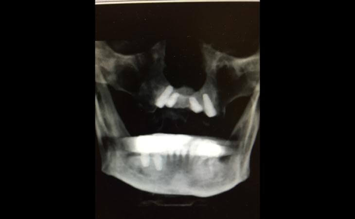 X-Ray Of Dental Implant Placement