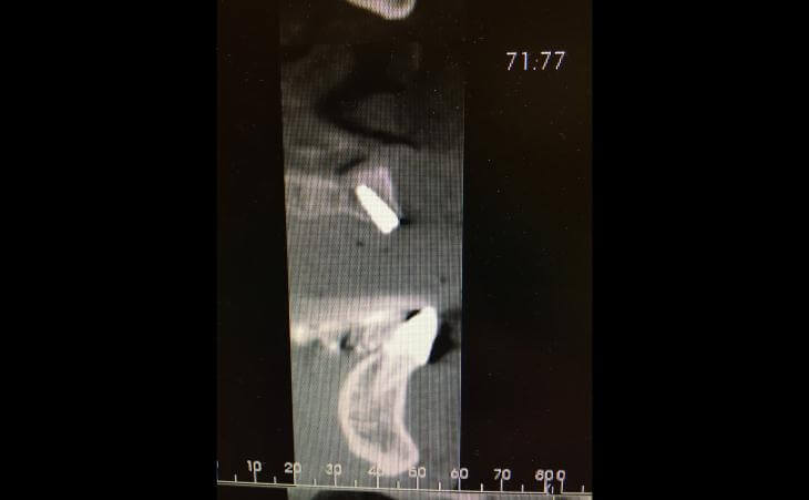 CT Scan Of Dental Implant Placement