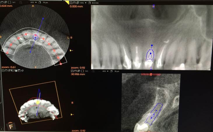 Medical Imaging For Planned Implant Position