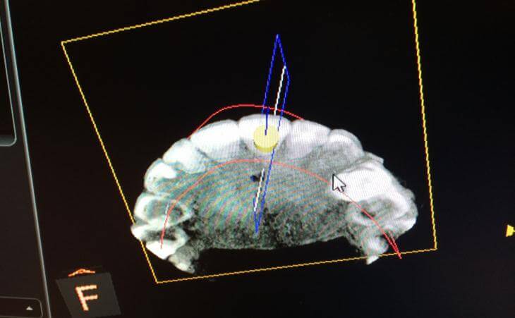 CT Scan For Dental Implants