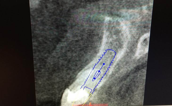 Ideal Dental Implant Position CT Scan