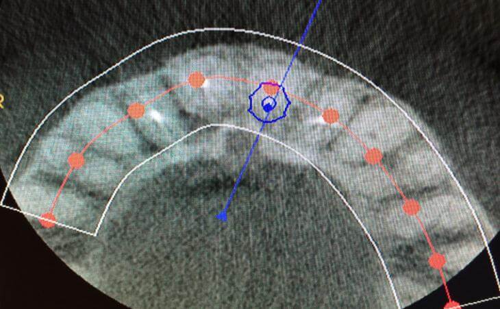 CAT Scan For Planned Implant Position