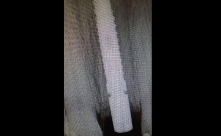 Dental Implant X-Ray Scan