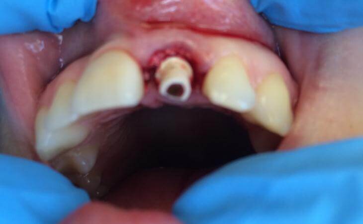 Temporary Abutment For Dental Implant