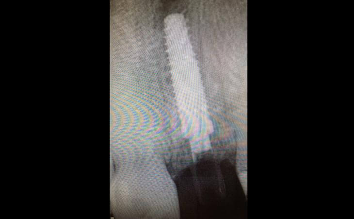Secure Dental Implant X-Ray